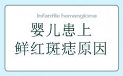 广州鲜红斑痣最好的医院-婴儿患上鲜红斑痣原因